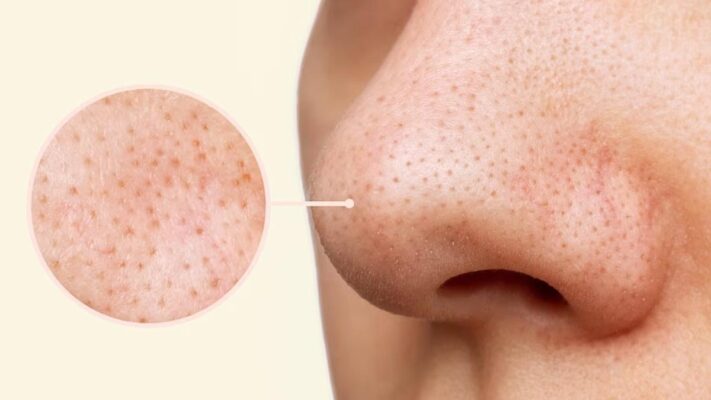 Trị mụn đầu đen